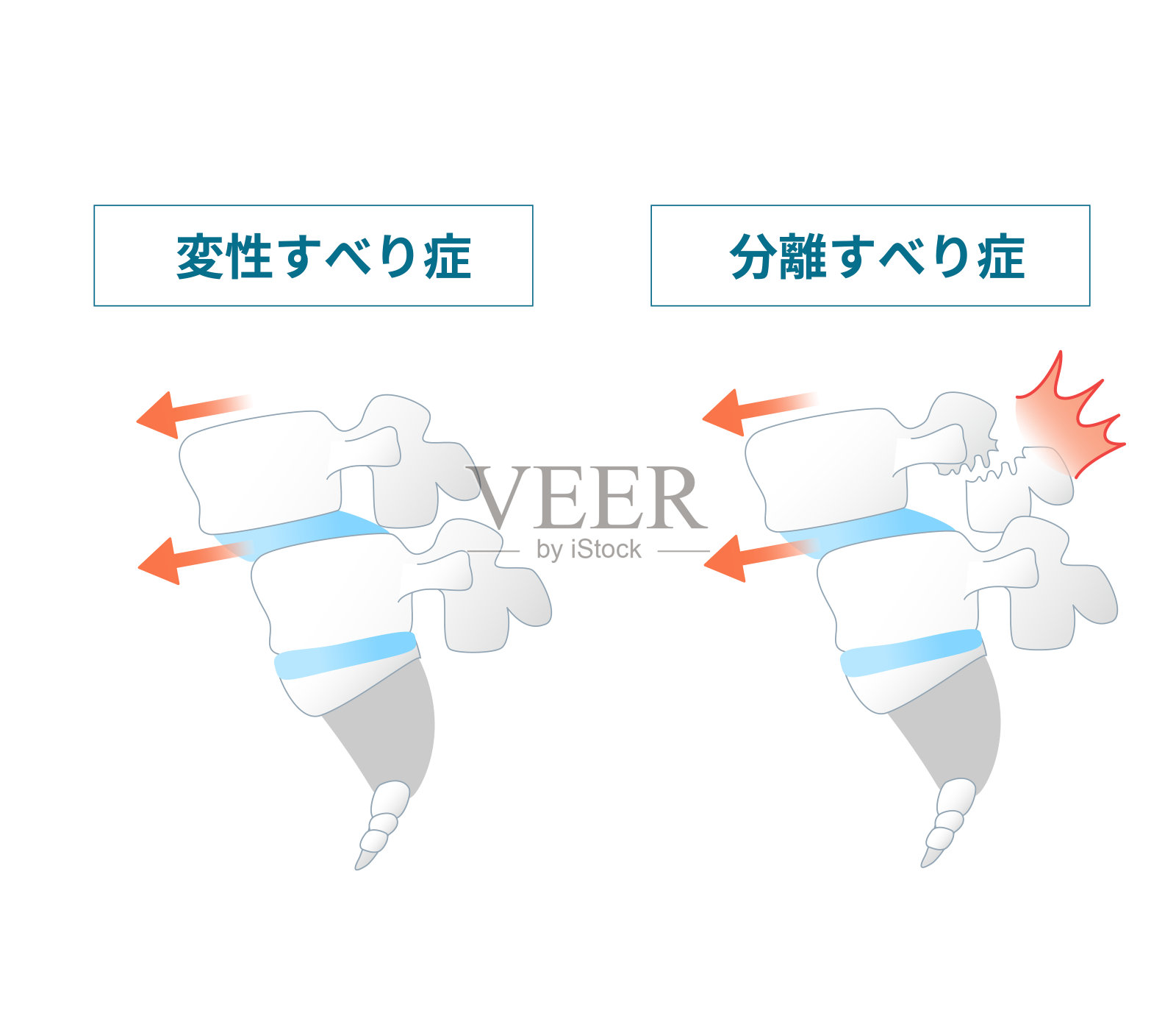 脊椎滑脱症状的说明插画图片素材