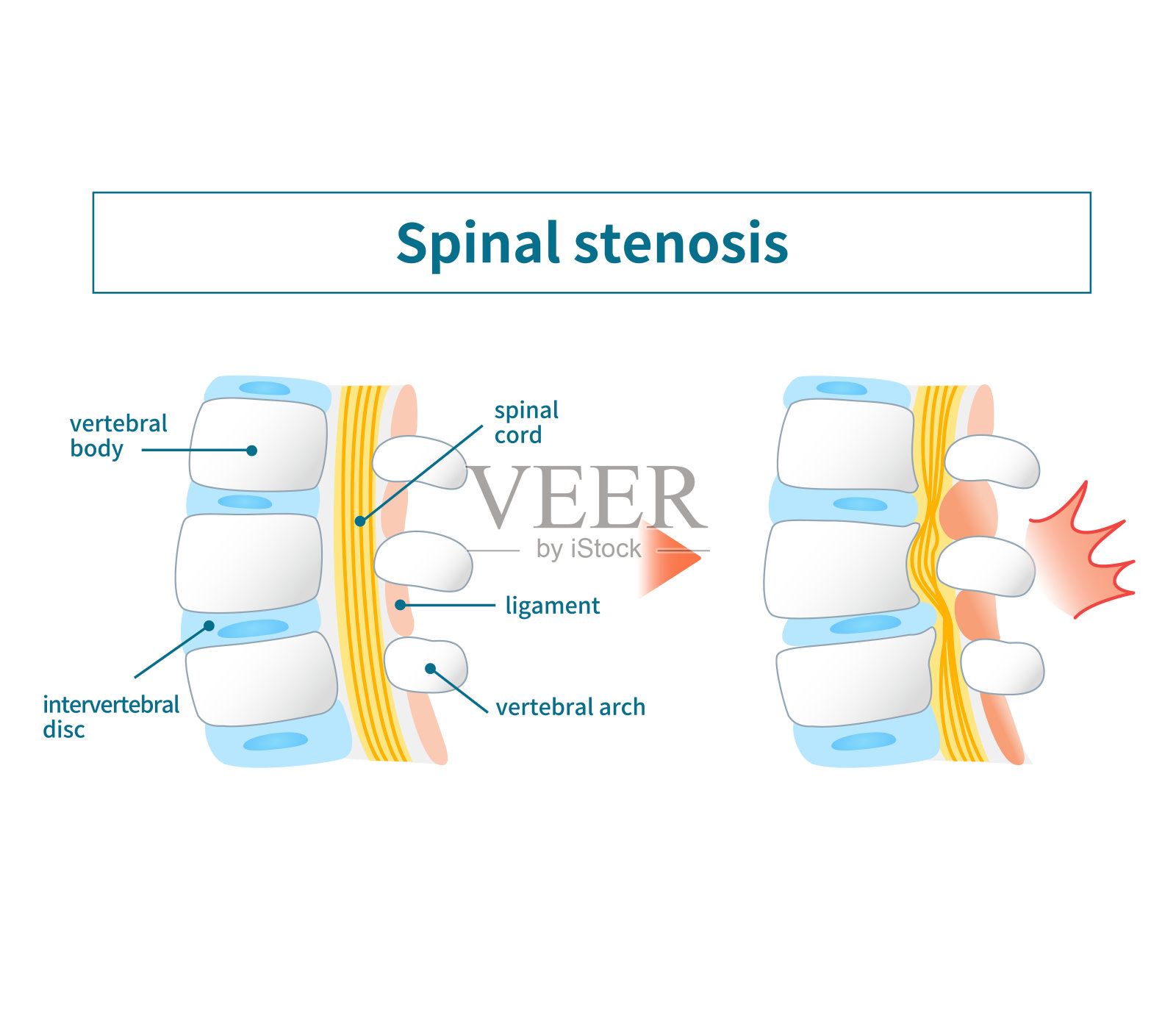 腰椎管狭窄图示插画图片素材