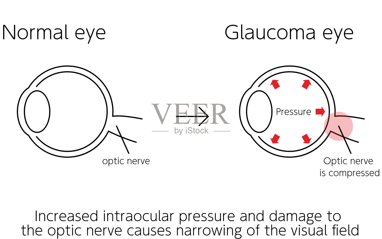 青光眼如何工作的插图，正常和青光眼，医学插图插画图片素材