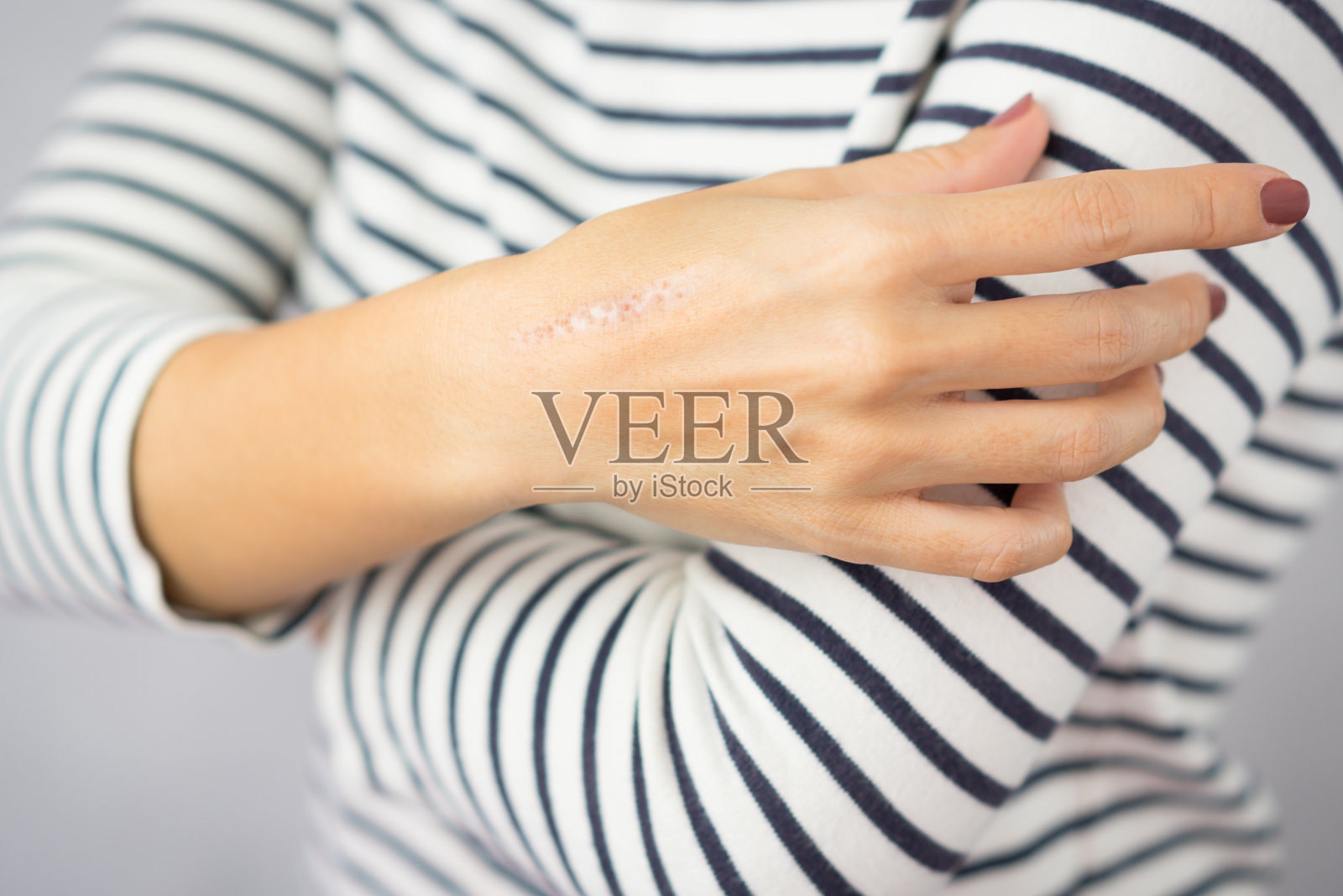 近距离烹饪油烧伤瘢痕的女人的手。照片摄影图片