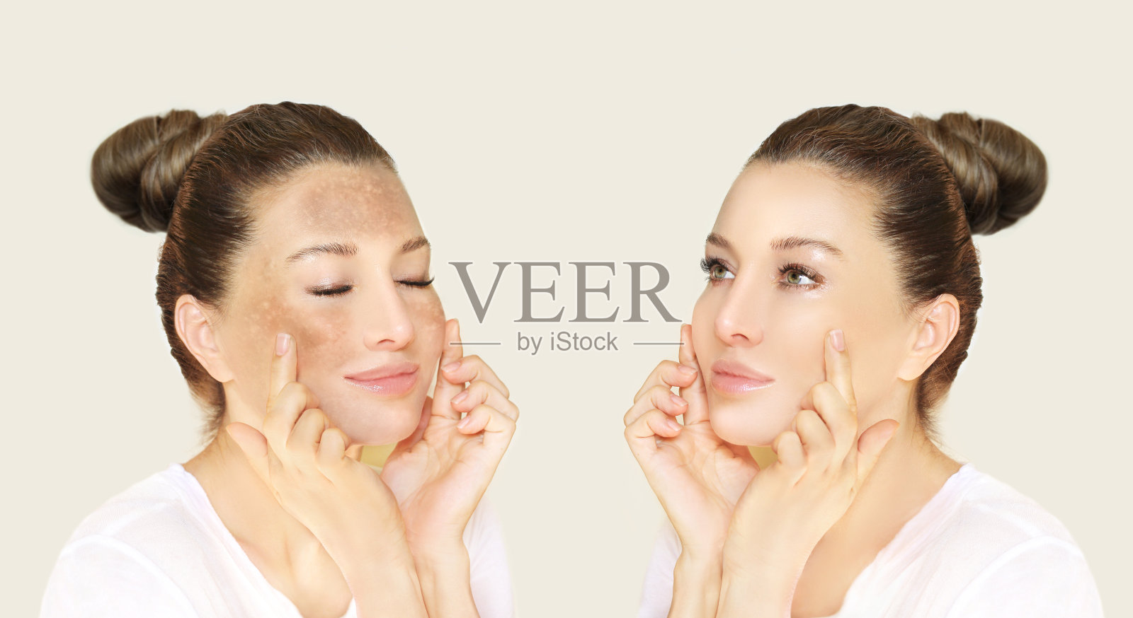 黑斑，雀斑，色素沉着(黄褐斑或黄褐斑)，概念-皮肤白化，皮肤白化，果酸，AHA，皮肤白化照片摄影图片