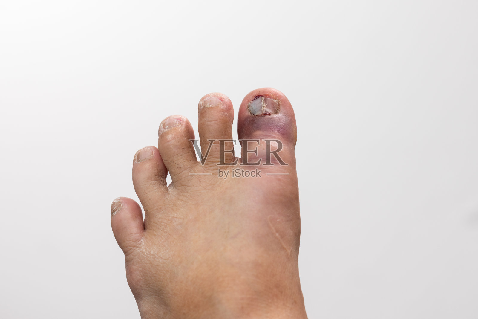 左脚趾甲瘀伤照片摄影图片