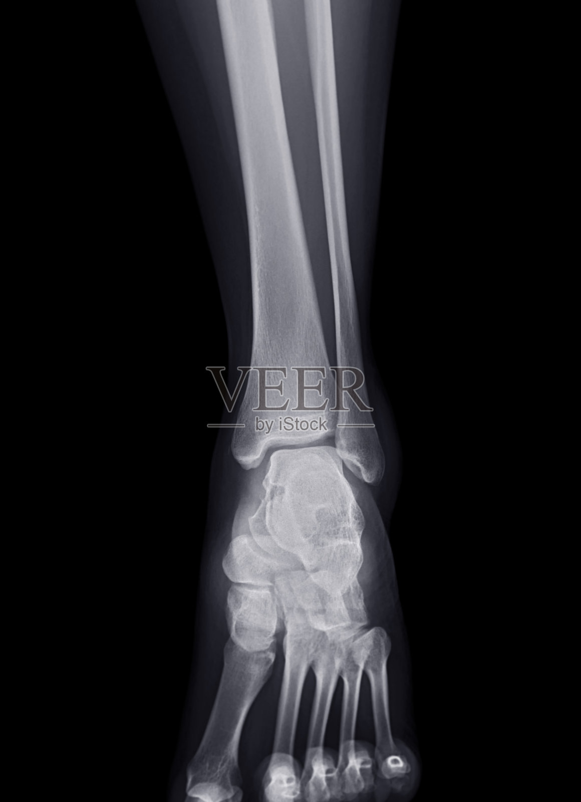踝关节x线片诊断胫骨、腓骨骨折。照片摄影图片