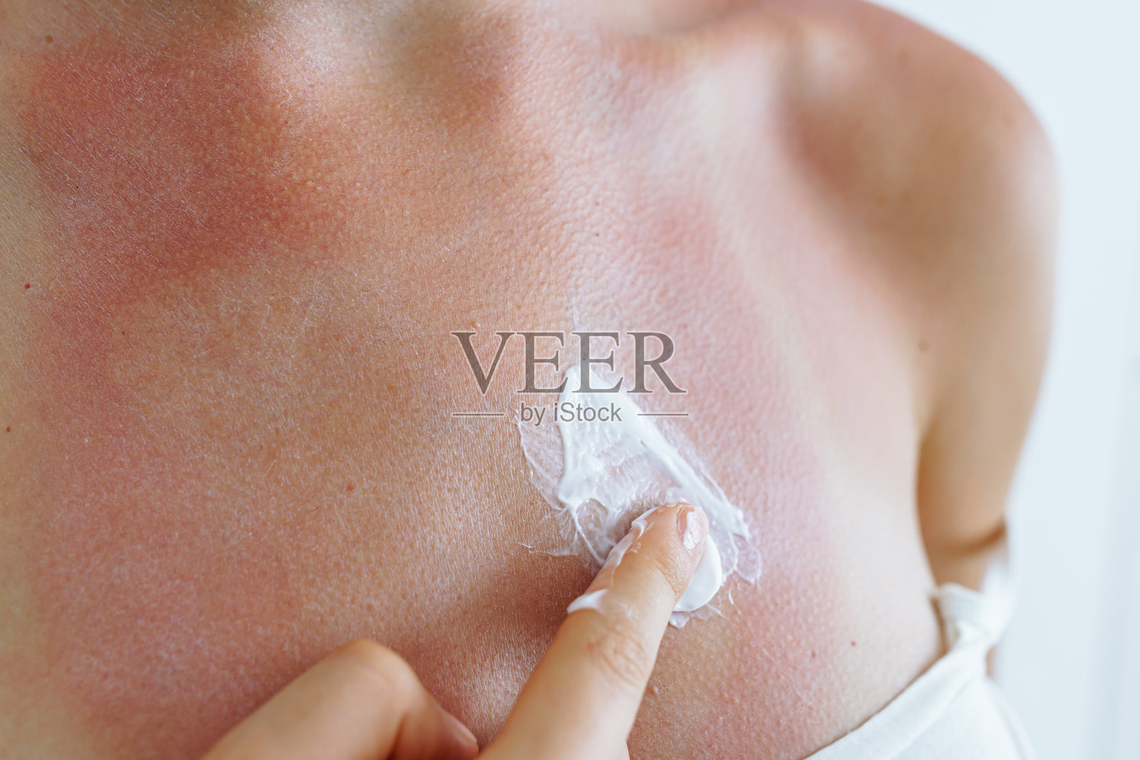 晒伤后，妇女的手在皮肤上涂抹抗烧伤膏照片摄影图片