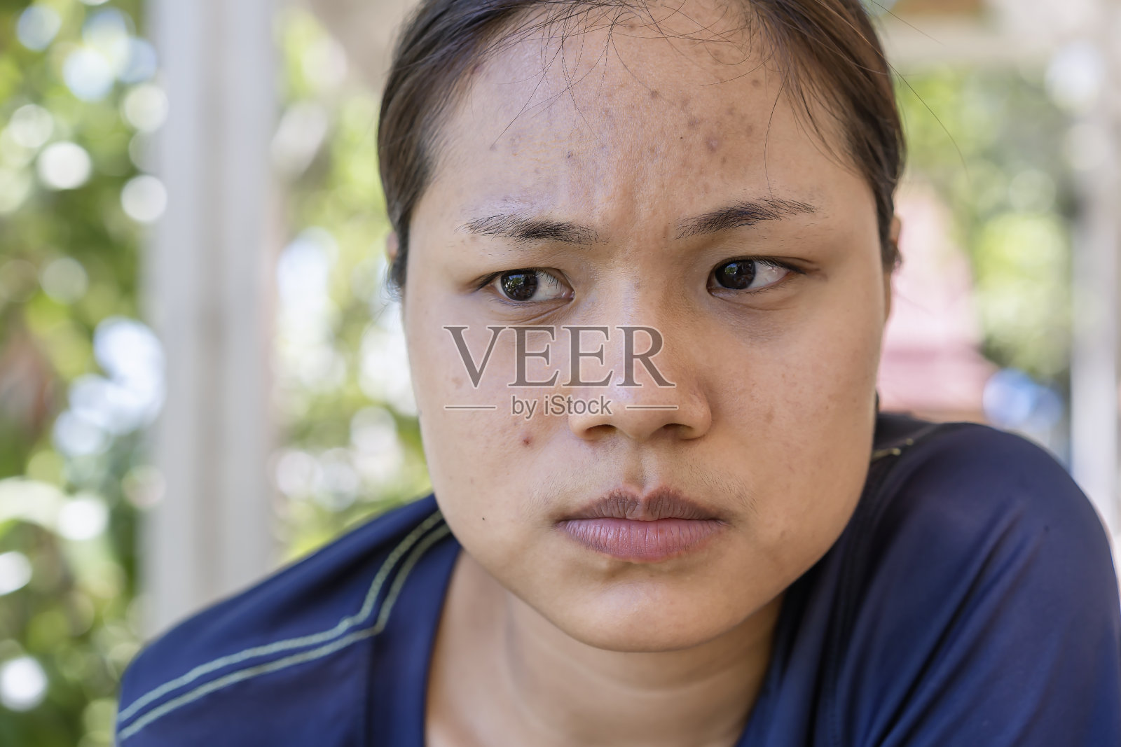 年轻的亚洲女性担心她的脸当她的皮肤问题在她的脸在自然背景。女性皮肤上的痤疮和疤痕问题。问题护肤健康理念。照片摄影图片