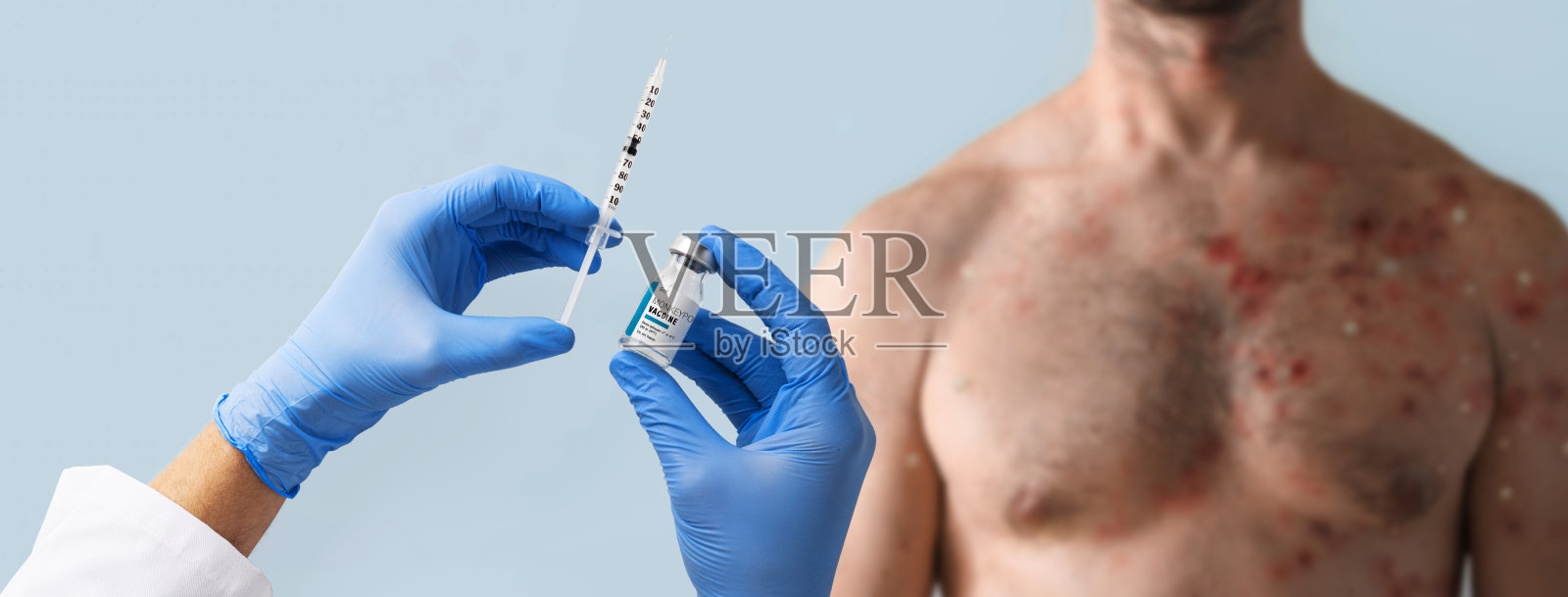 医生手拿猴痘疫苗与男性胸部感染水疱疹背景猴痘。照片摄影图片
