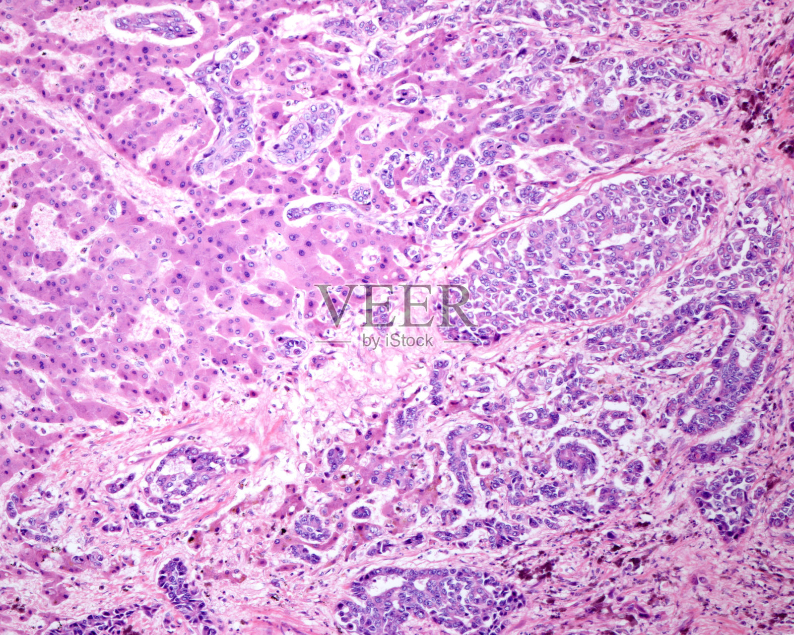 人类的肝脏胆管癌照片摄影图片