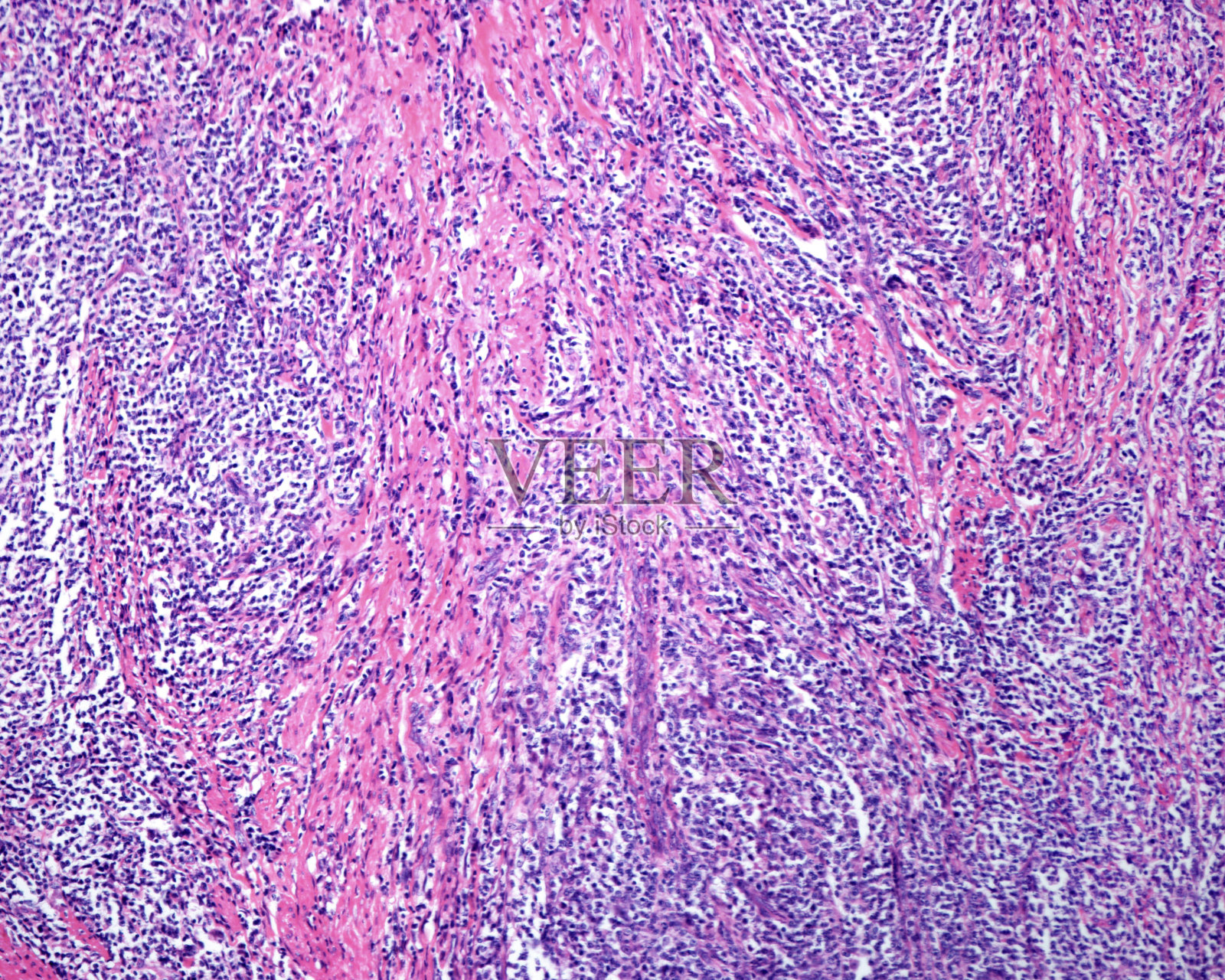 人类的胃。Reticulosarcoma照片摄影图片