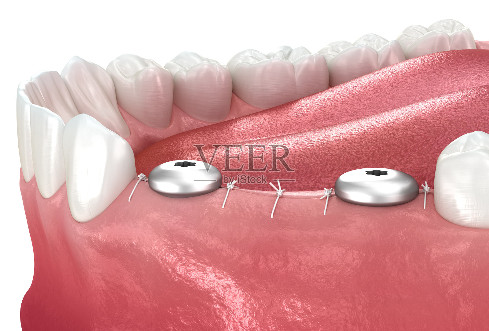 牙龈前过植牙。医学精准的3D插画。插画图片素材