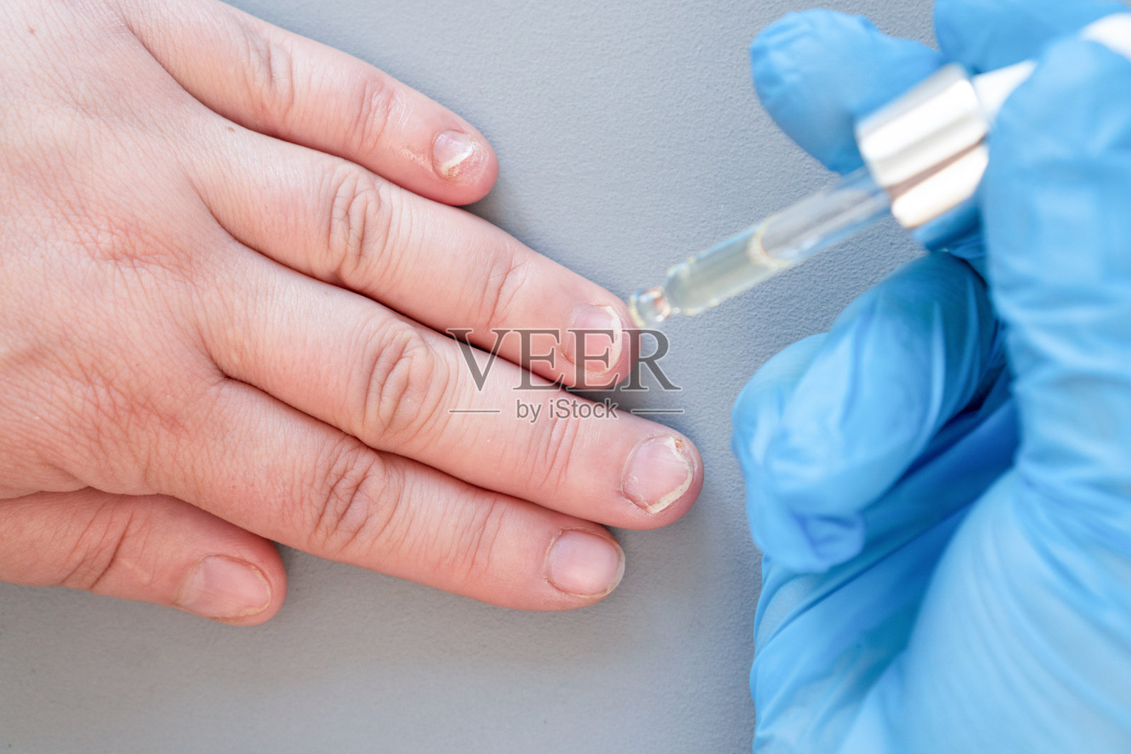 医生用吸管把药滴在手指上。用指甲真菌刷的特写。甲癣:指甲从甲床上脱离照片摄影图片