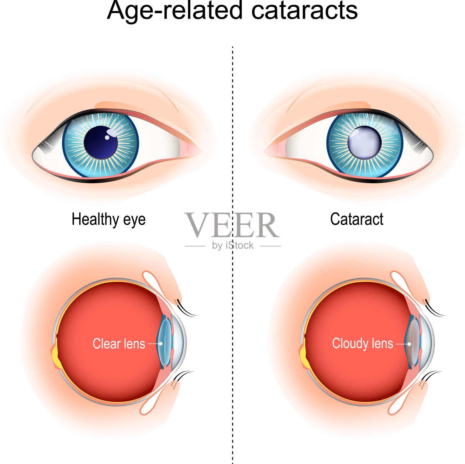 白内障与年龄有关的视力问题插画图片素材