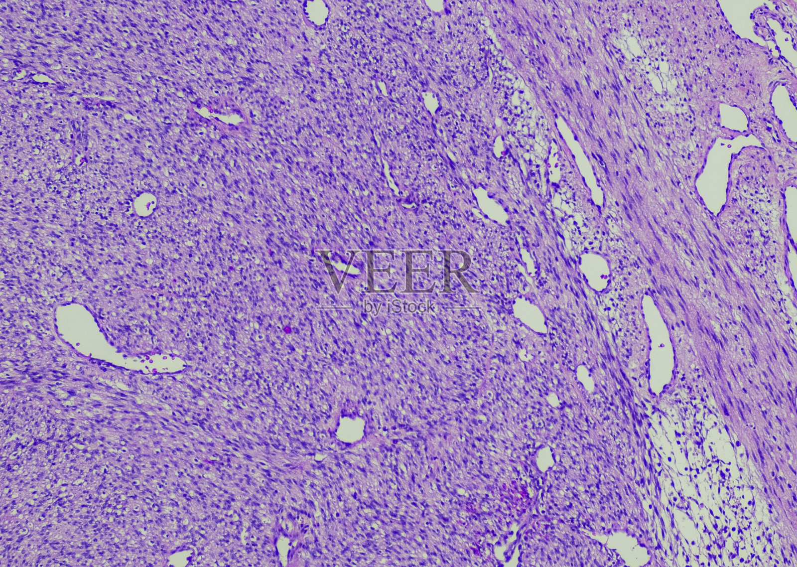 先天性中胚层肾瘤照片摄影图片