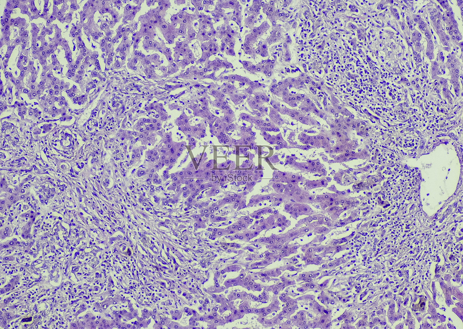 原发性胆汁性肝硬化照片摄影图片