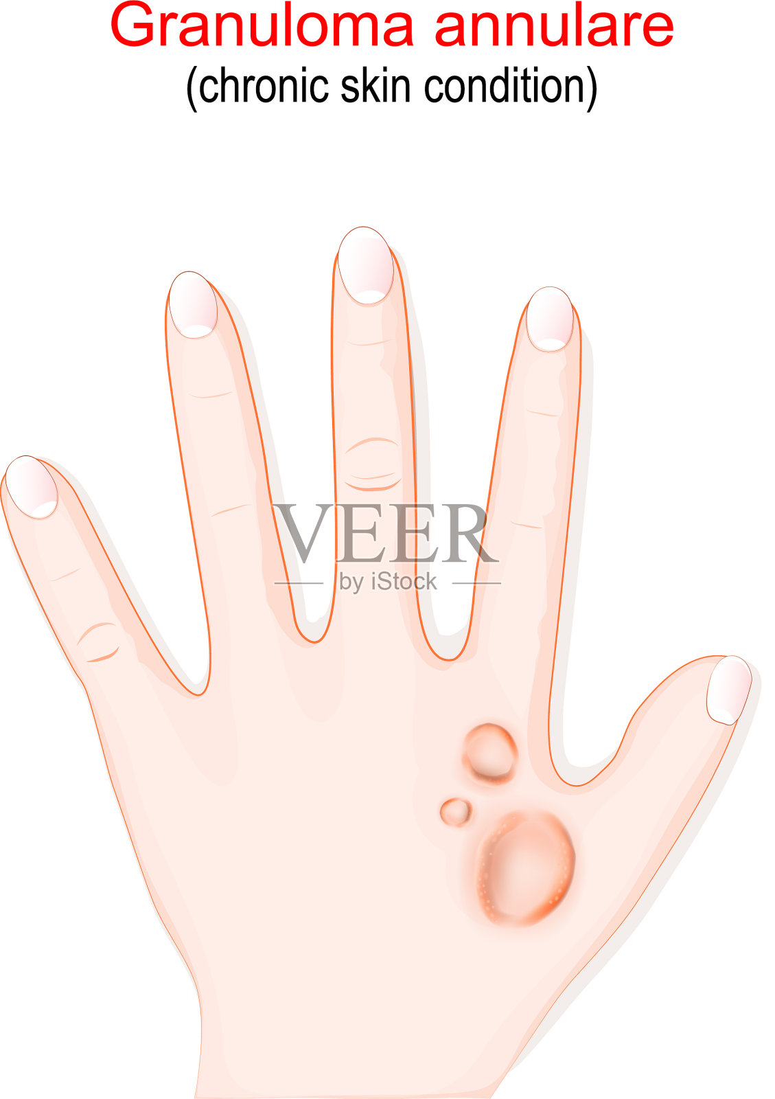 环状肉芽肿是慢性皮肤疾病插画图片素材