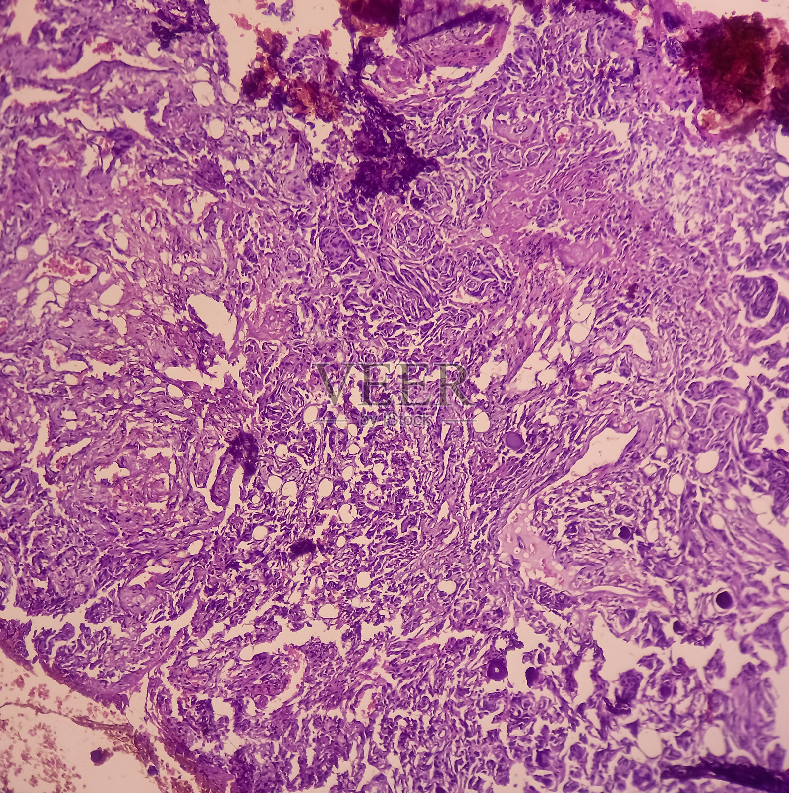 脊背肿瘤(活检):沙粒瘤性脑膜瘤。重度钙化的颅内或脊柱肿块，显示脊柱软组织。照片摄影图片