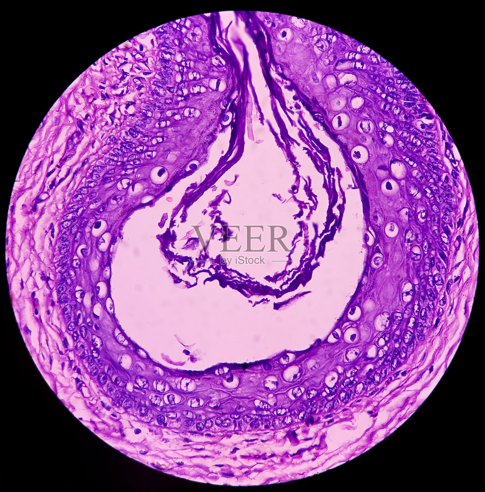 颈部肿块癌，转移性腺癌，显示皮肤，脂肪组织，睾丸囊性畸胎瘤颗粒状成分。照片摄影图片