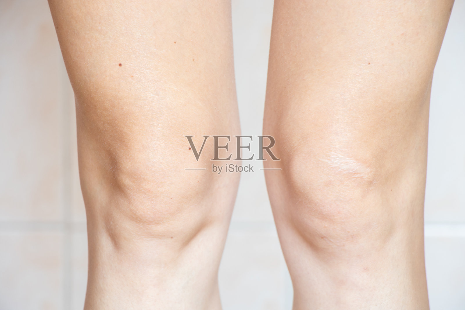 一个小女孩膝盖上有一道老伤疤的特写，腿上照片摄影图片