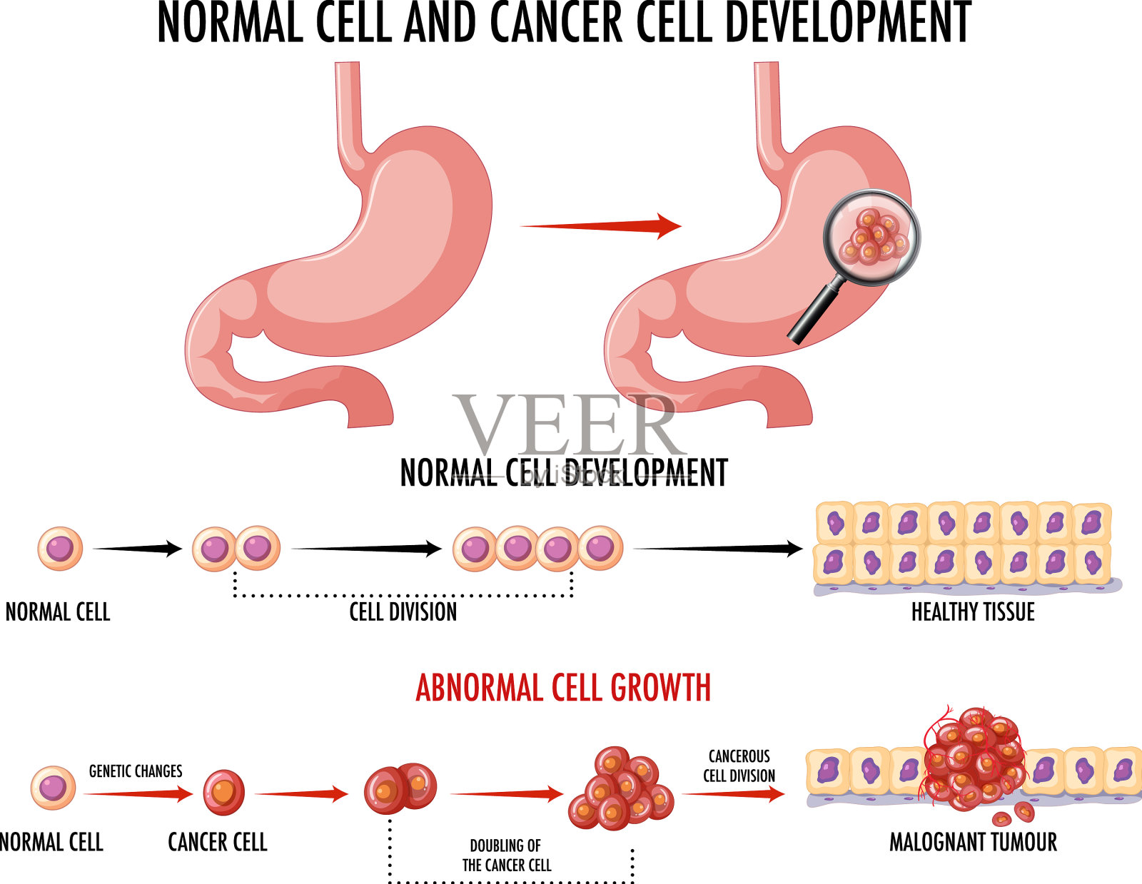 图示癌症发展过程插画图片素材