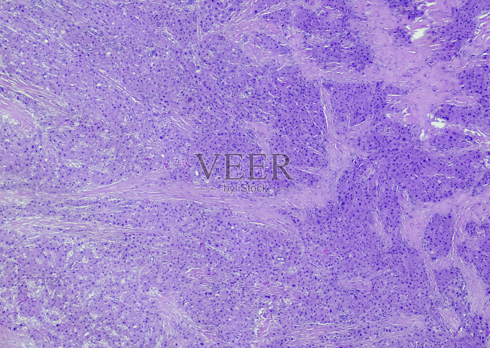 Fibrolamellar肝细胞癌照片摄影图片