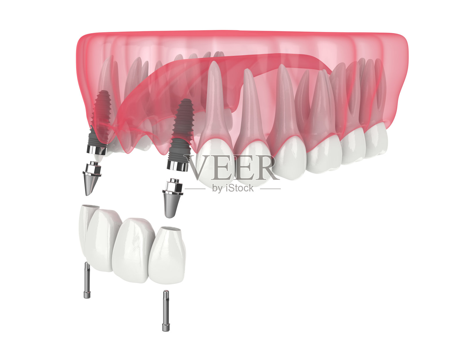颌面三维渲染，采用种植牙悬臂桥支撑颌面三维渲染照片摄影图片