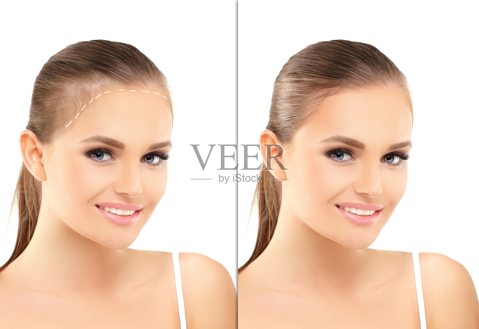 头发稀疏和脱发，女性秃顶，植发照片摄影图片