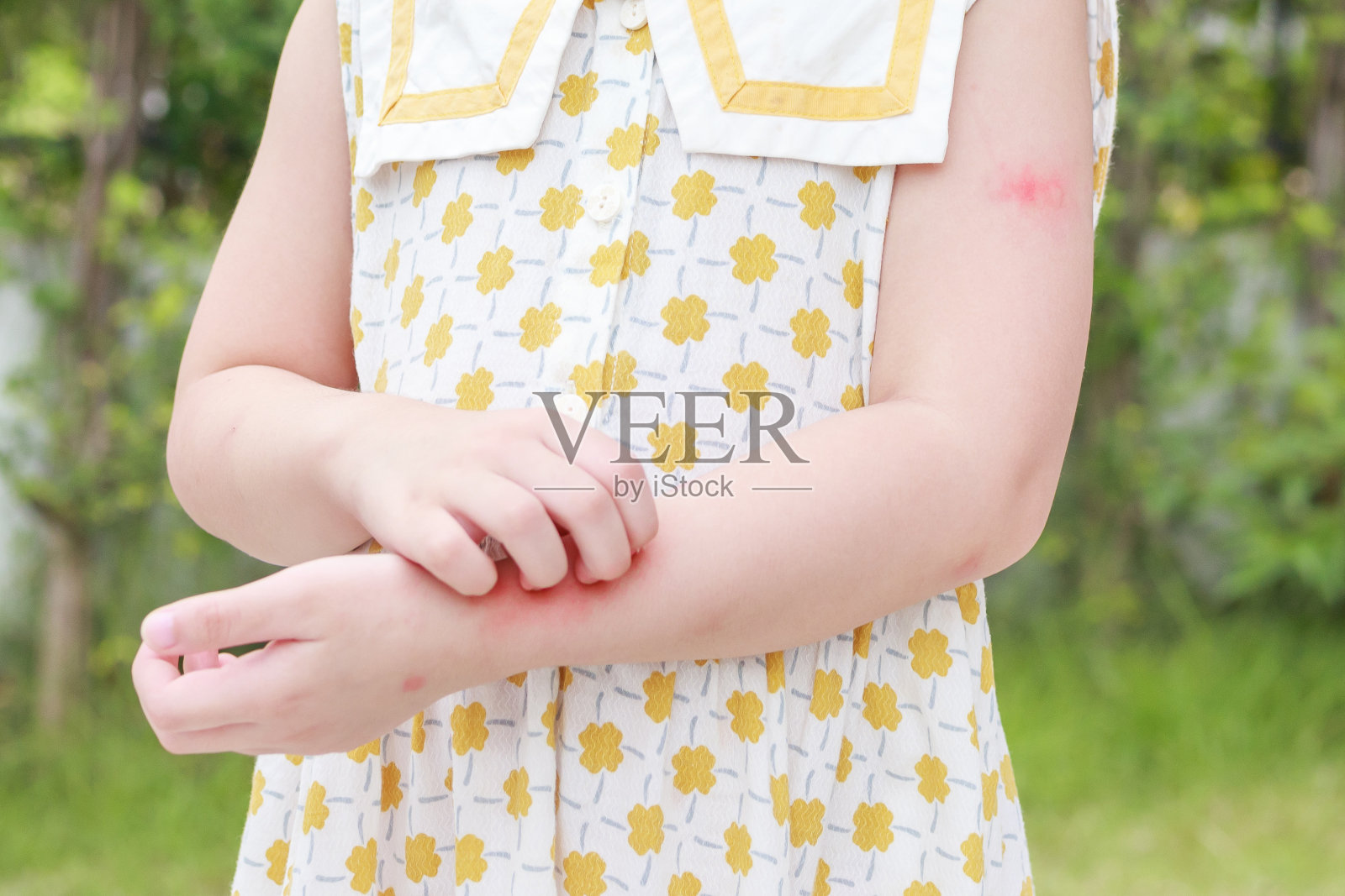 小女孩有皮疹，过敏，手臂瘙痒，抓挠照片摄影图片