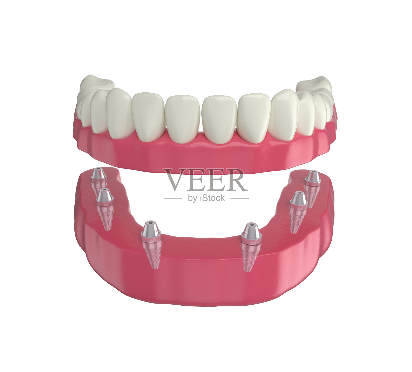 义齿，6个覆盖义齿种植体，下弓，3d渲染照片摄影图片