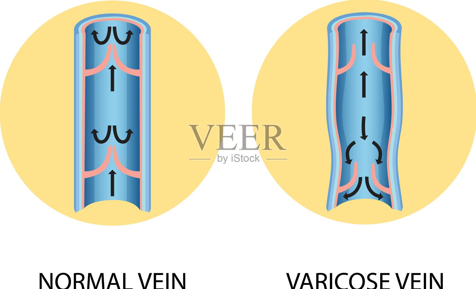 正常静脉与静脉曲张的比较插画图片素材