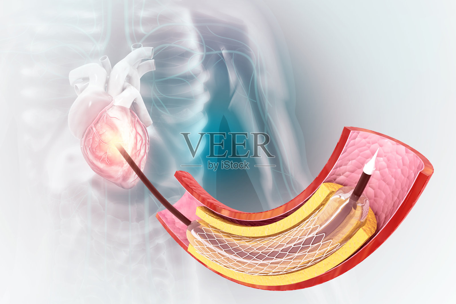 植入血管的支架和导管。三维演示照片摄影图片