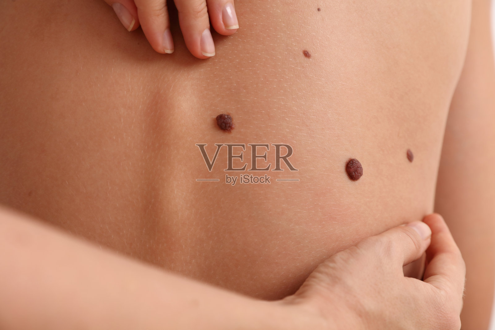 皮肤科医生仔细检查病人的胎记。预防的概念照片摄影图片