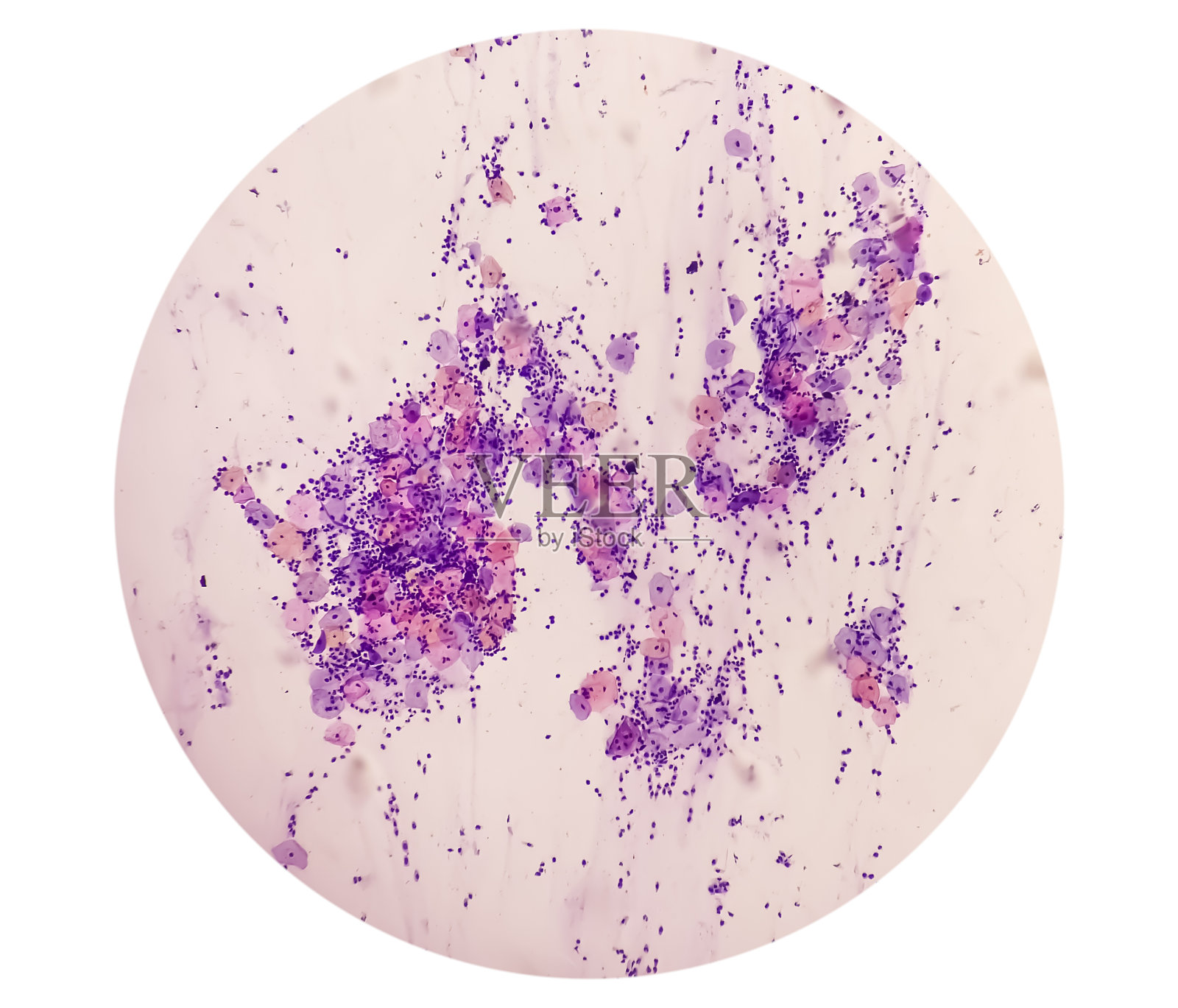 PAP涂片显微镜视图显示上皮内病变恶性肿瘤(NILM)严重阴性。宫颈癌的诊断。照片摄影图片