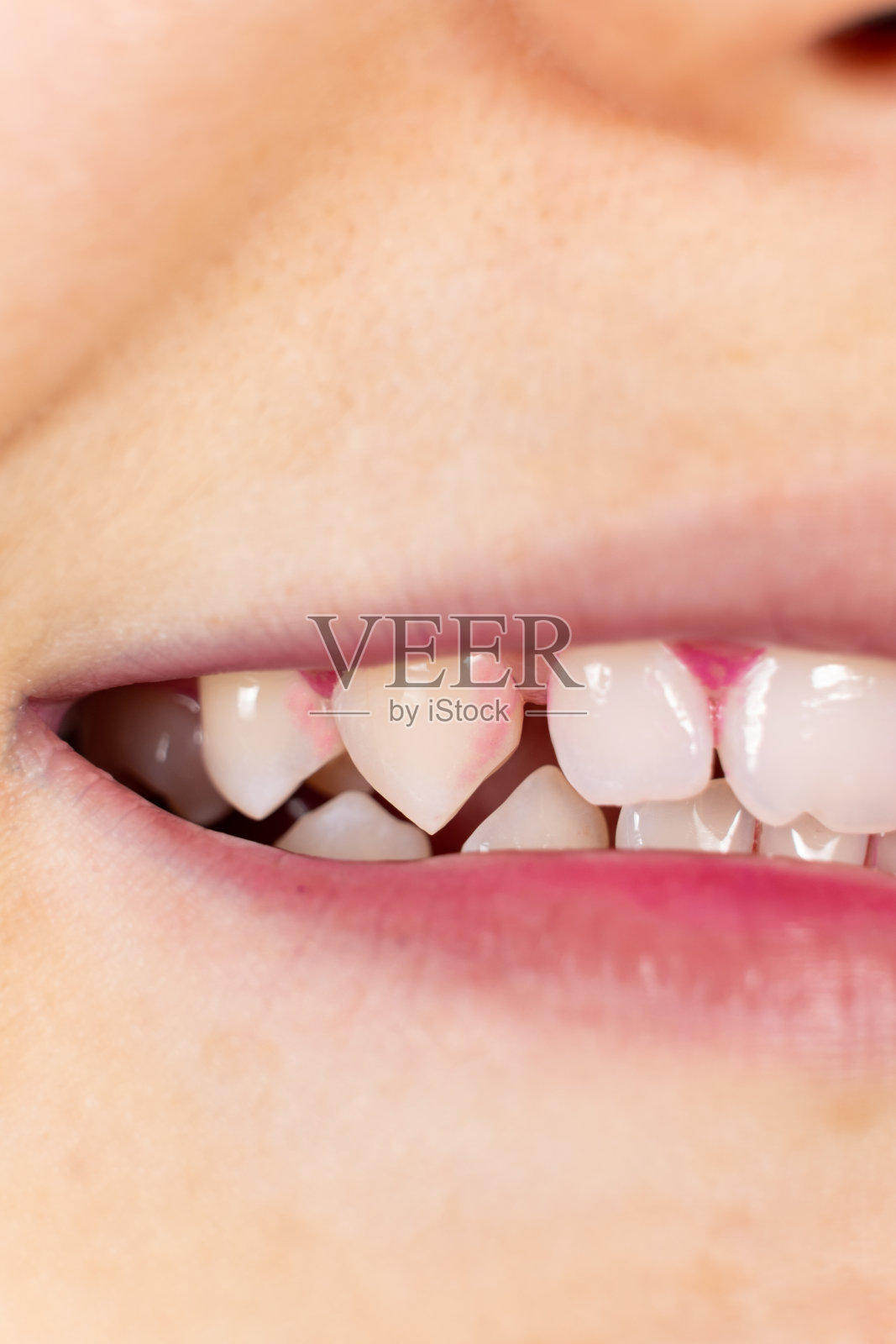 人类牙齿上的菌斑带有指示片，呈粉红色。照片摄影图片