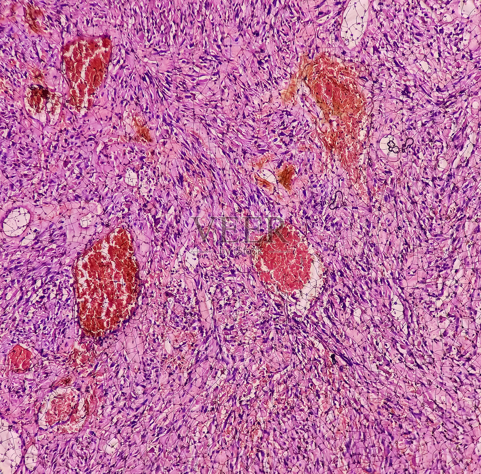 小肠肿块(活检):恶性胃肠道间质瘤(GIST)，恶性周围神经鞘瘤(MPNST)，罕见恶性间质病变。神经性肉瘤。照片摄影图片