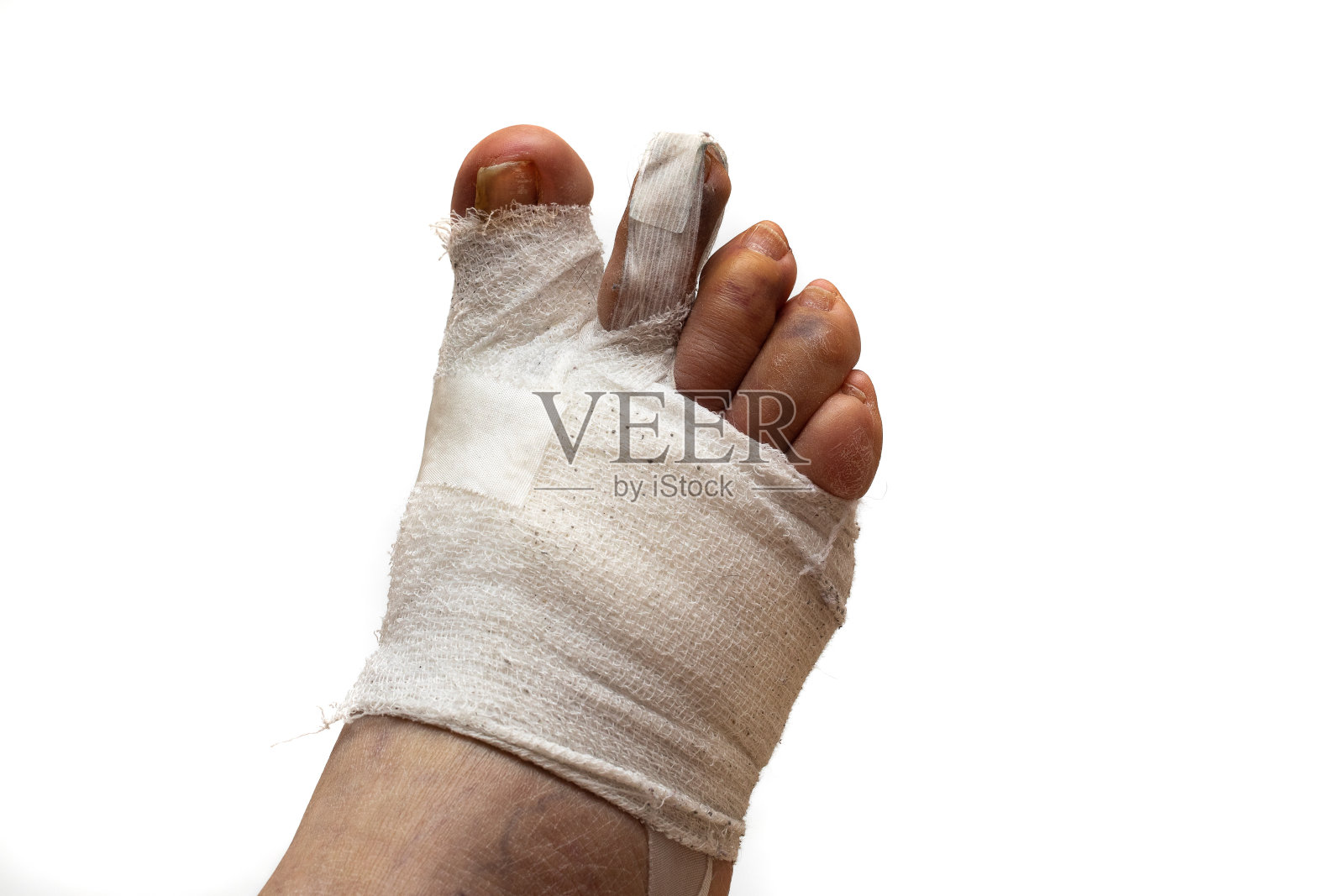 拇囊炎术后脚部包扎照片摄影图片