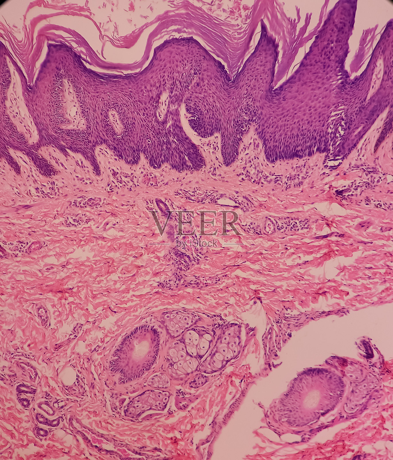 皮肤(活组织检查):脂溢性角化病，表皮角化过度，棘皮增生，伪角囊肿，局灶区鳞状漩涡。照片摄影图片