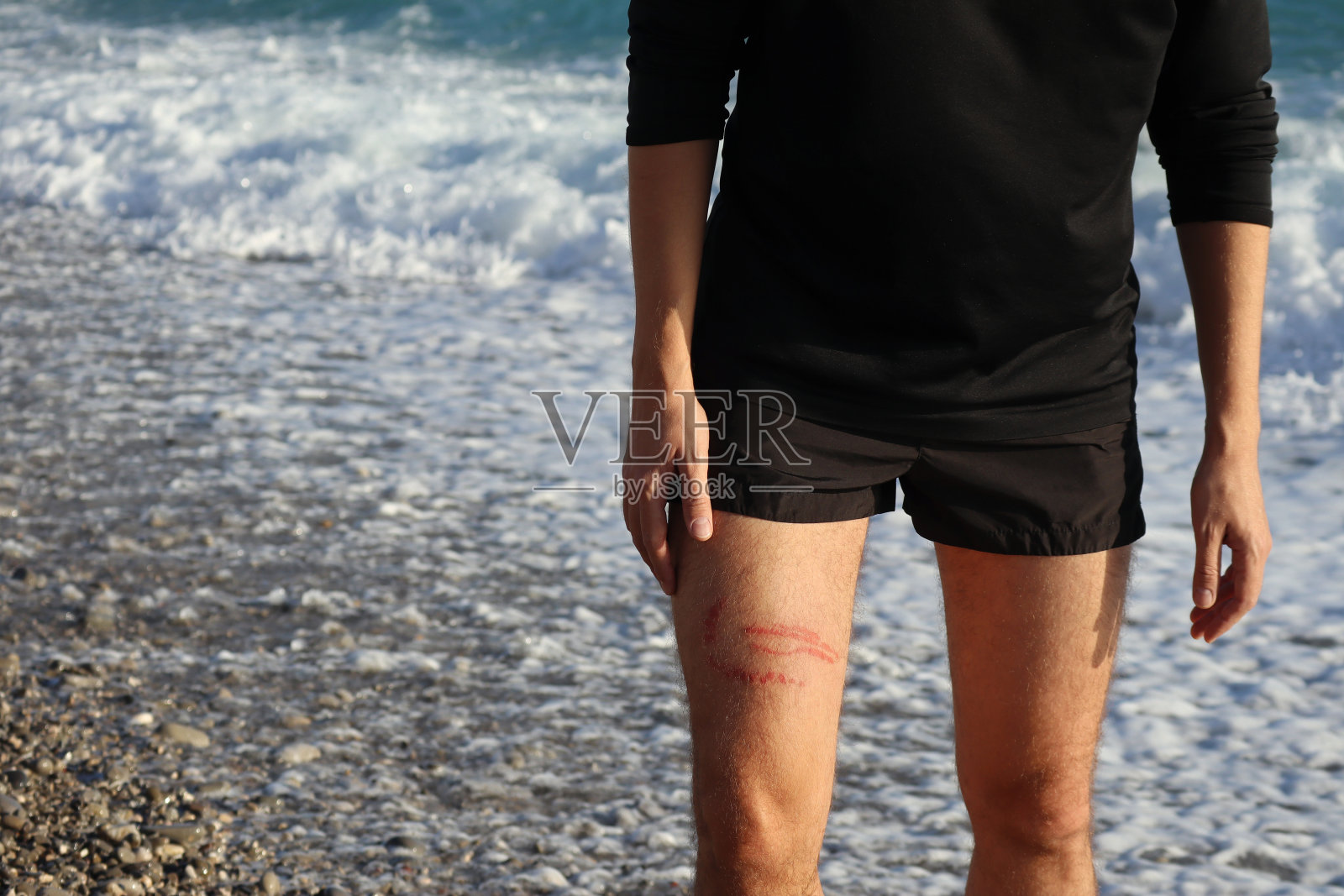 一个男人的腿上被水母蛰伤了照片摄影图片