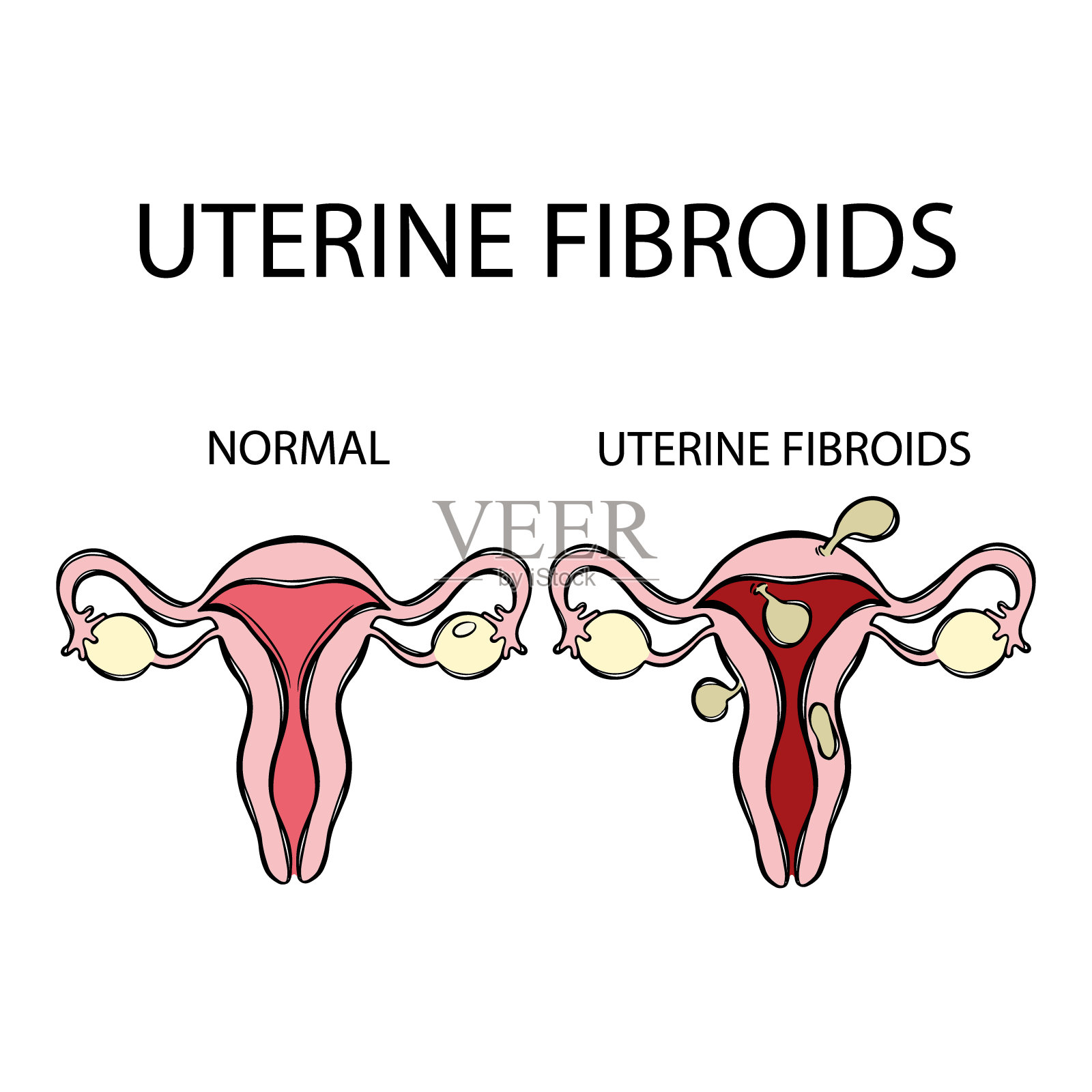 子宫肌瘤与正常女性生殖教育套装插画图片素材