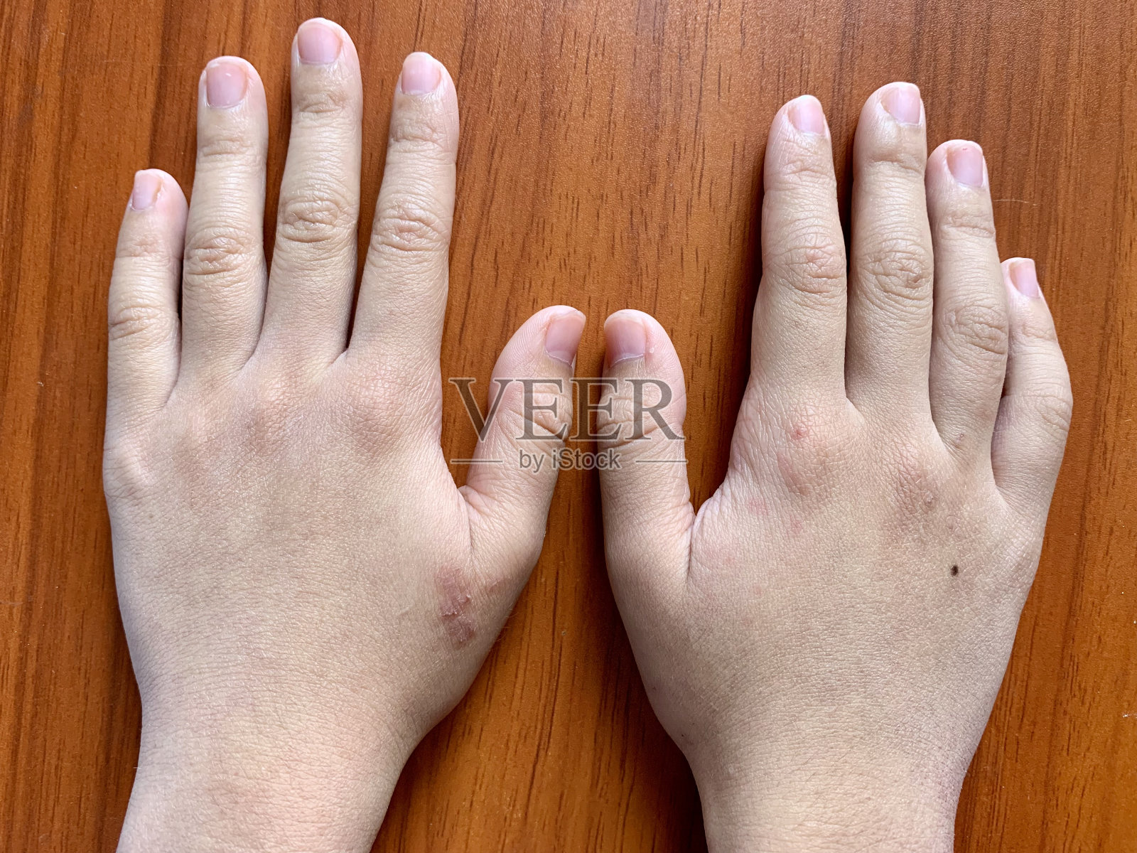 亚洲男性手发绀或周围发绀或手发蓝照片摄影图片