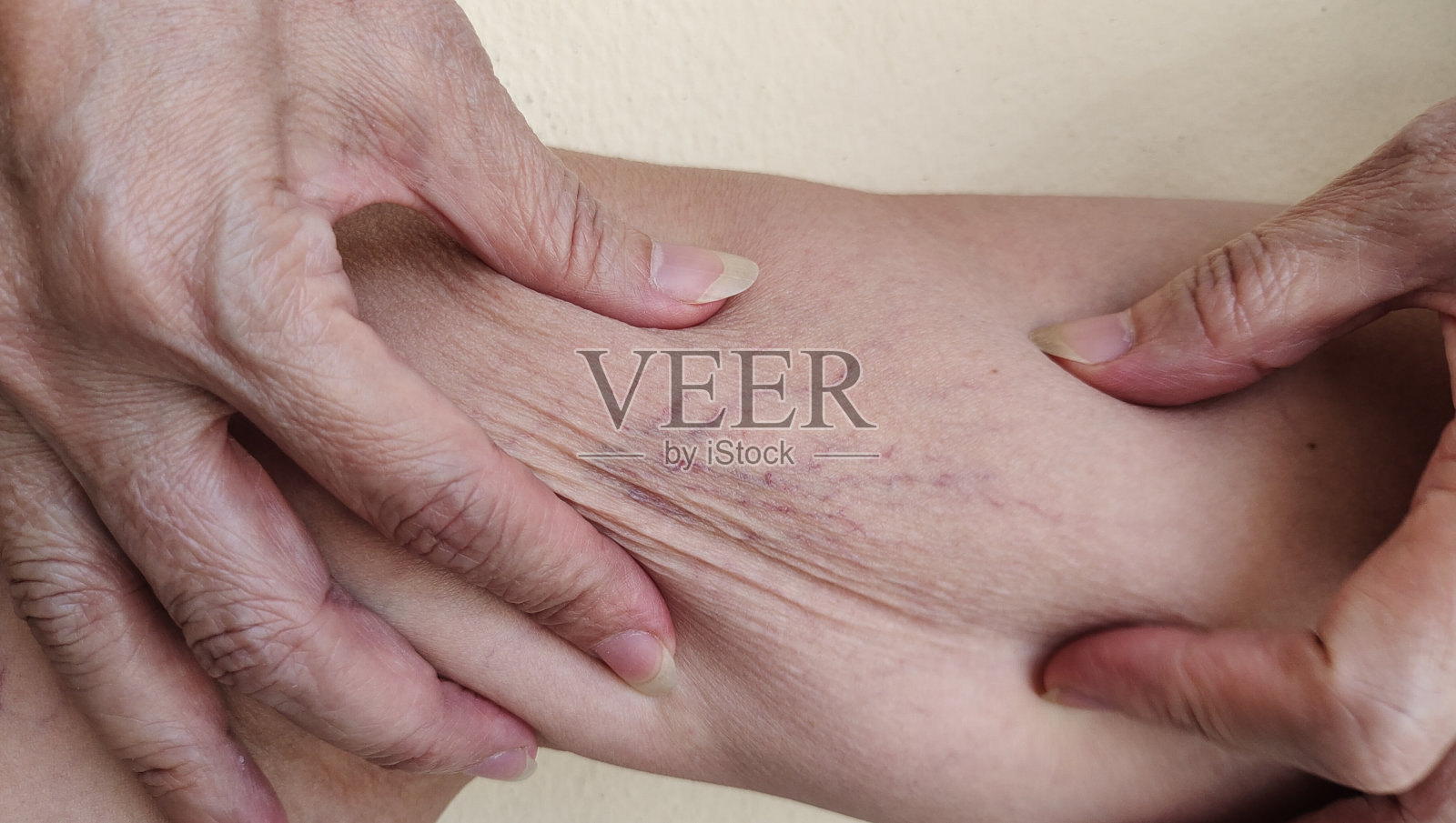 腿上的蜘蛛静脉曲张。照片摄影图片