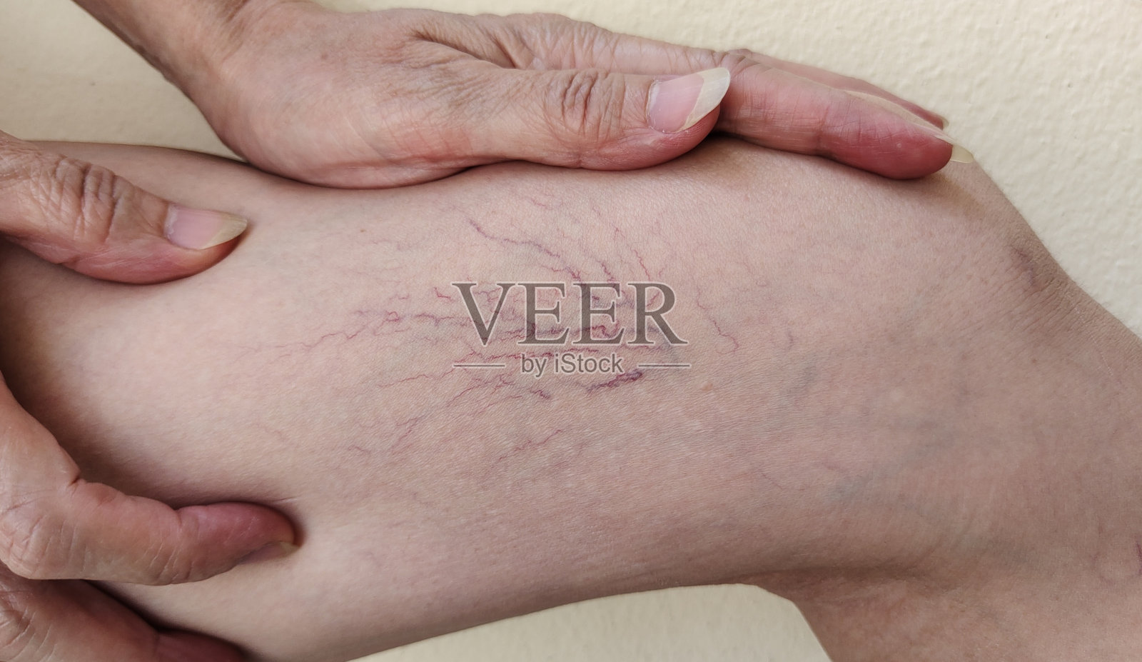 腿上的蜘蛛静脉曲张。照片摄影图片