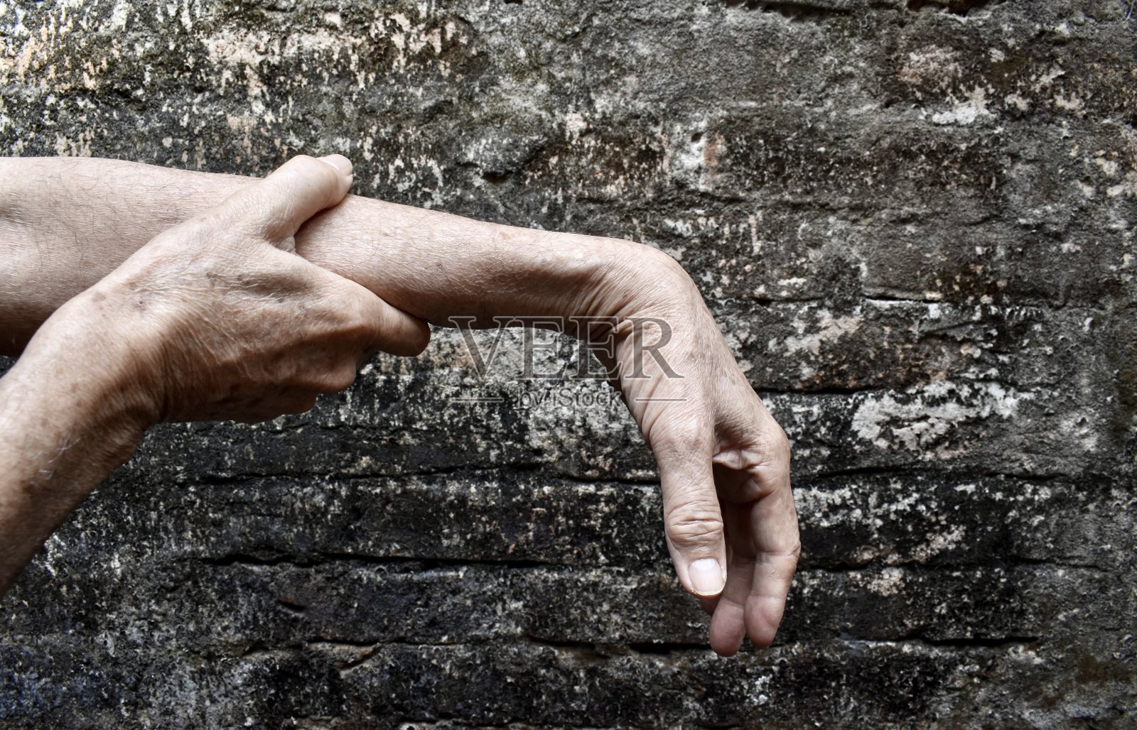 桡神经损伤或手腕下垂照片摄影图片