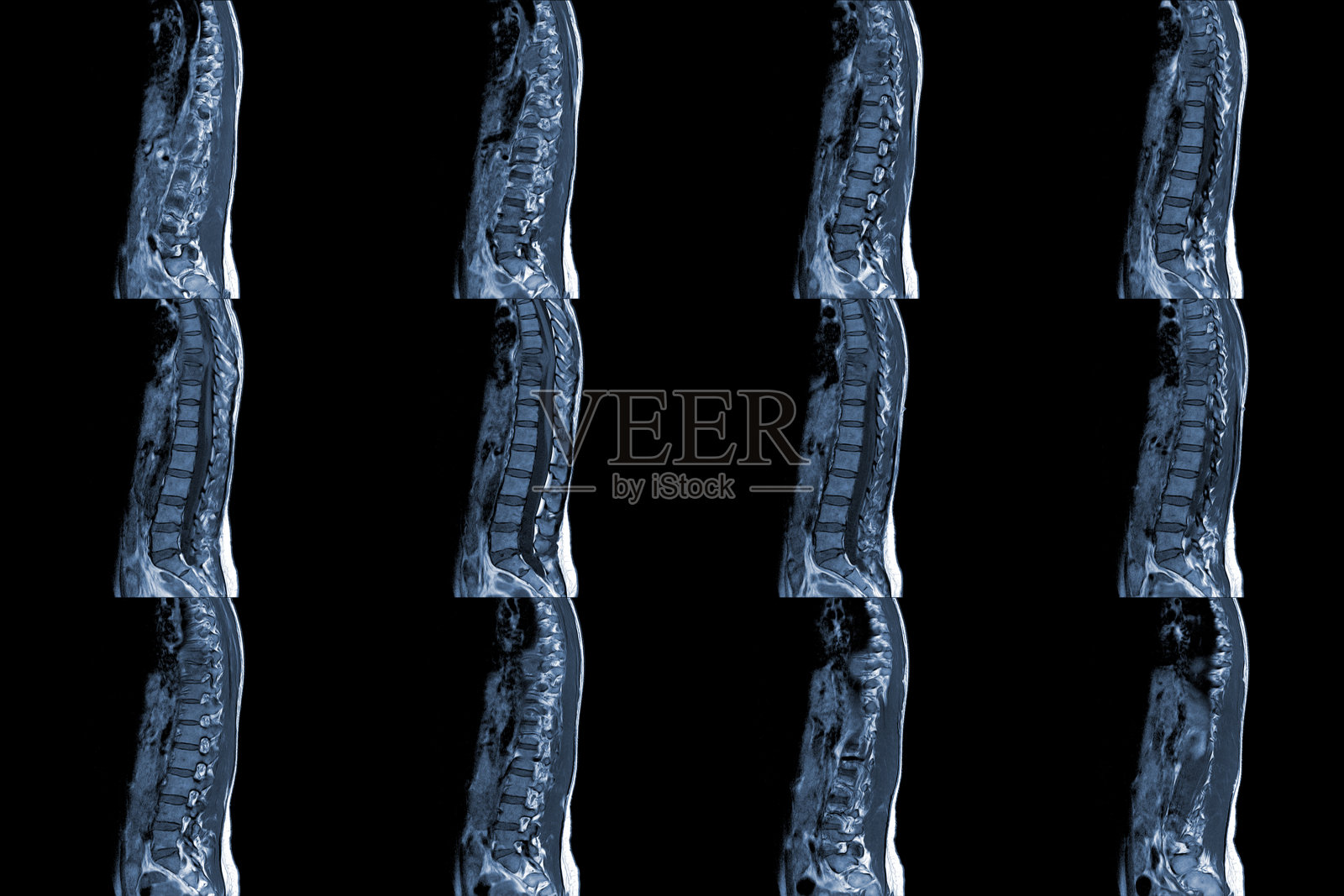 胸椎矢状位MRI检查T9压缩性骨折并发背痛病史照片摄影图片