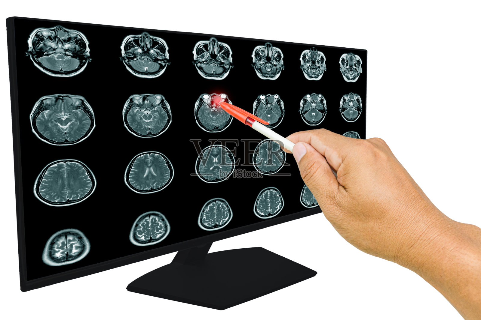 医生报告肿瘤MRI，矢状面。一个56岁的男人，有或没有对比媒体，保健和教育理念。照片摄影图片