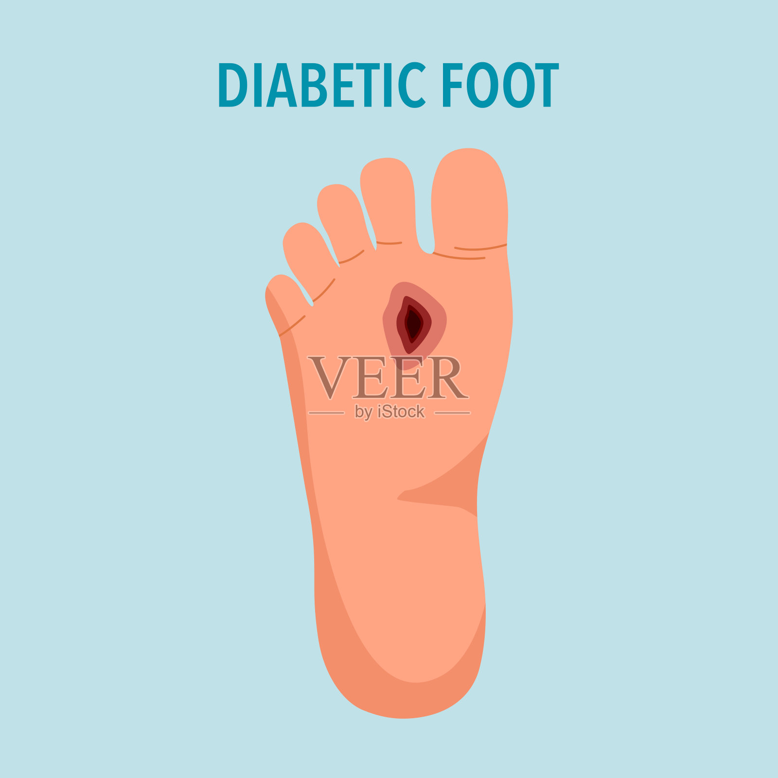 糖尿病足综合征概念矢量插图。插画图片素材