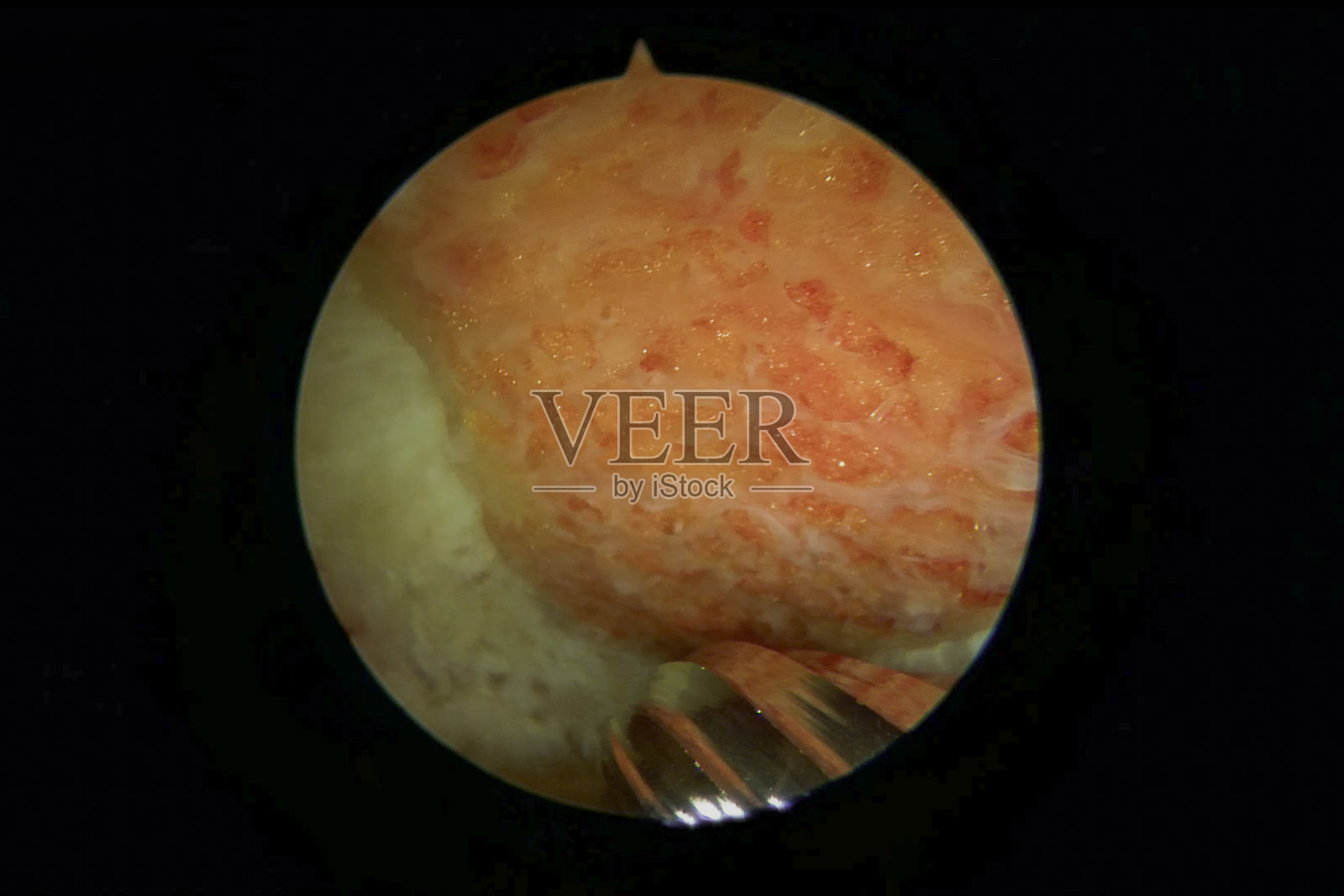 肩部肩峰成形术的关节镜观察照片摄影图片