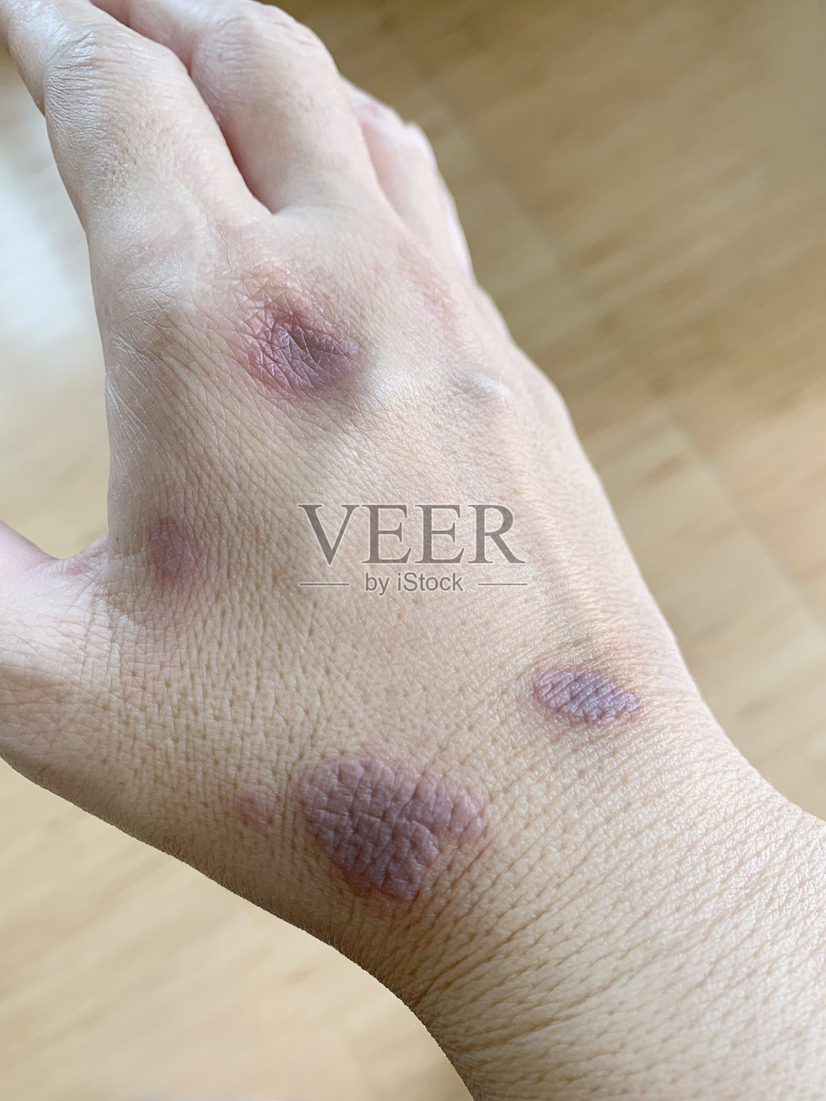 食用油溅到手上造成的伤口照片摄影图片