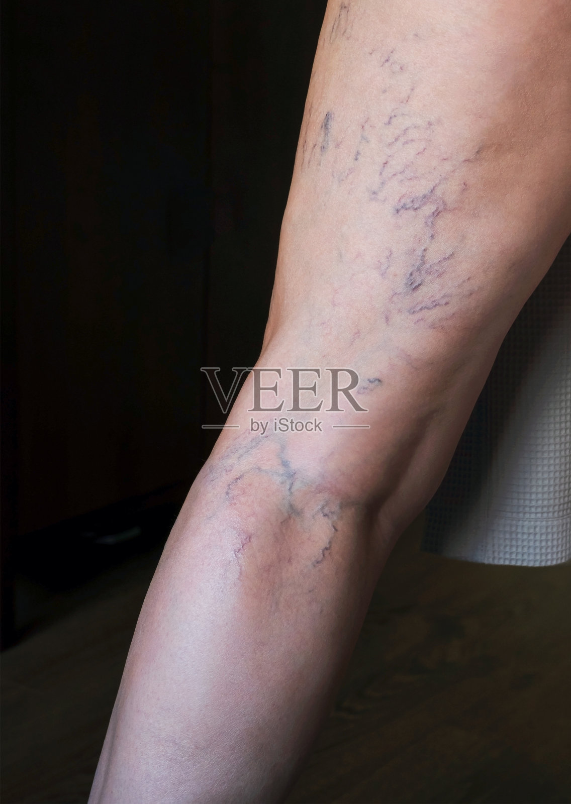 腿部皮肤老化。叶脉和脂肪团的出现静脉疾病静脉曲张特写镜头照片摄影图片