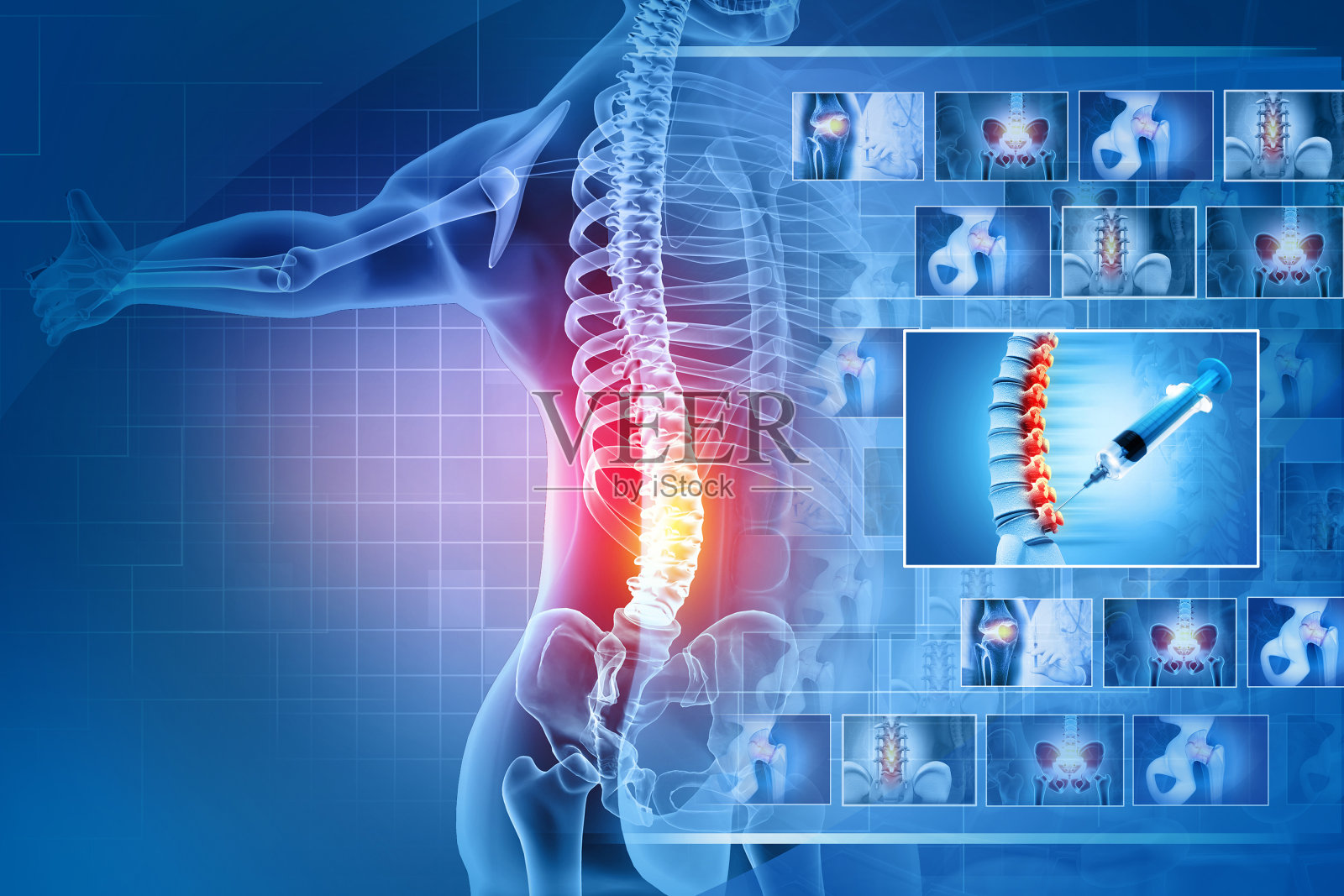 脊椎疼痛，背部疼痛，腰椎注射，红色突出，x光片。三维演示照片摄影图片