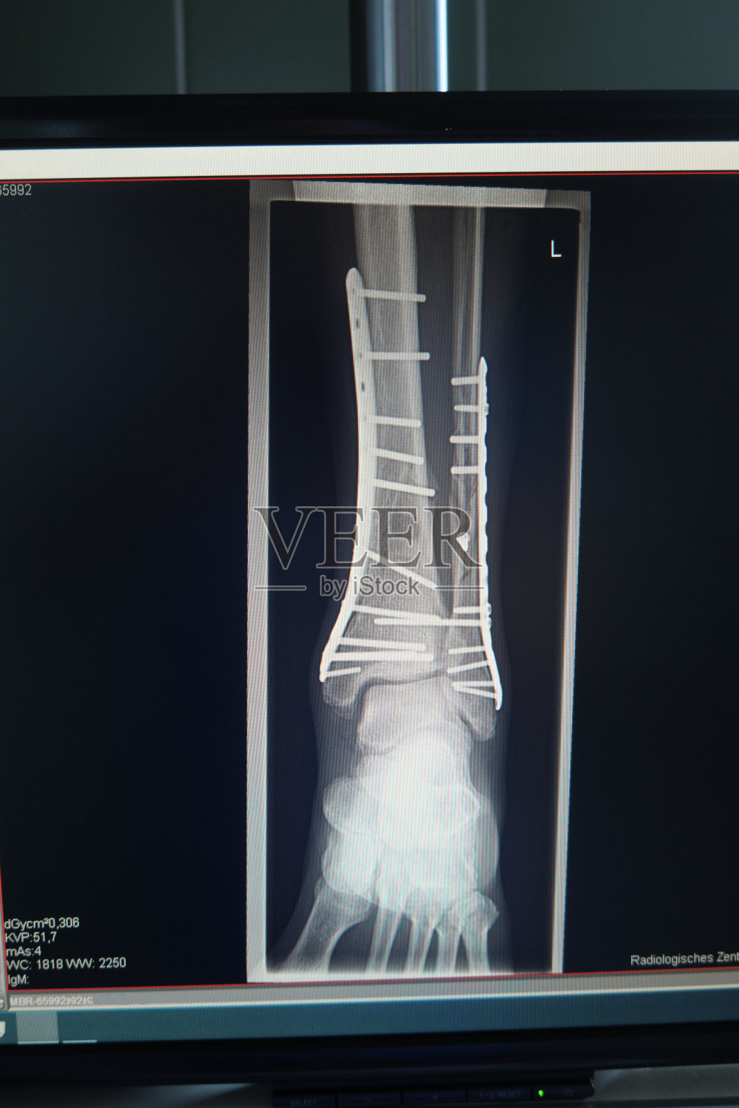 x光片显示踝关节骨折，用钢板和螺钉治疗照片摄影图片