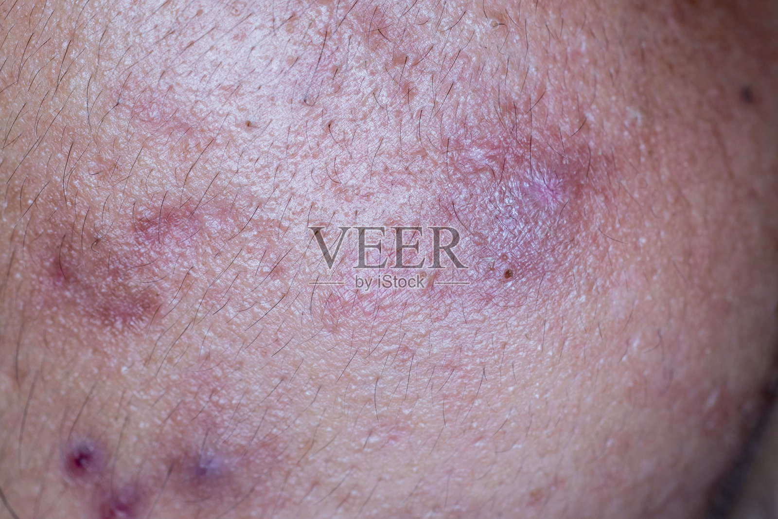 临床上因面部痤疮引起的皮肤病变。照片摄影图片